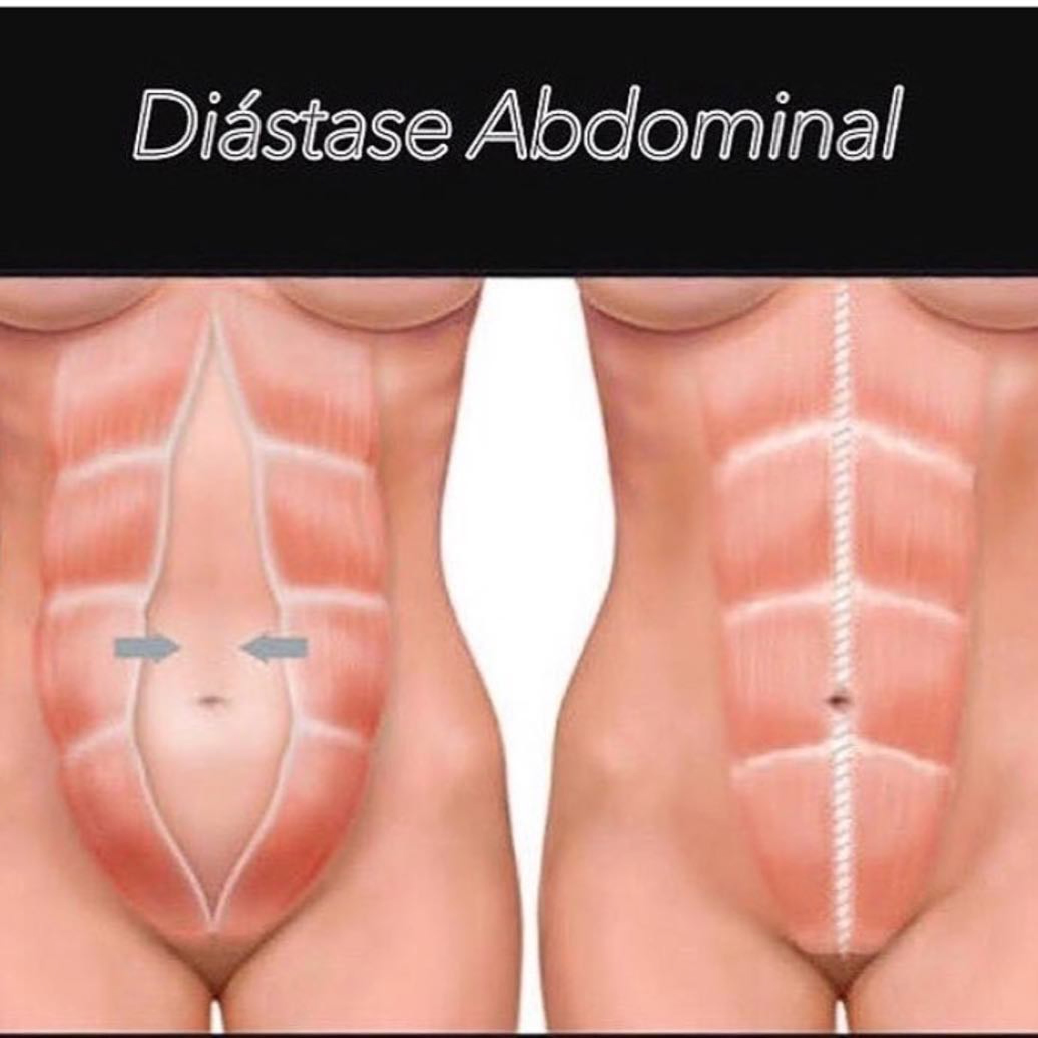 Cirurgia plástica do abdomen: abdominoplastia - Dra. Daniele Pace